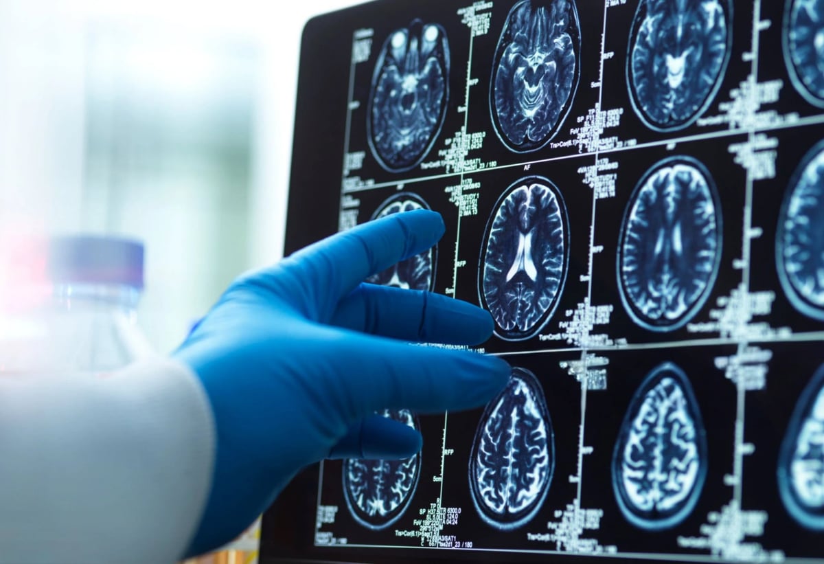 Brain scan representing methamphetamine addiction and brain healing neuroscience